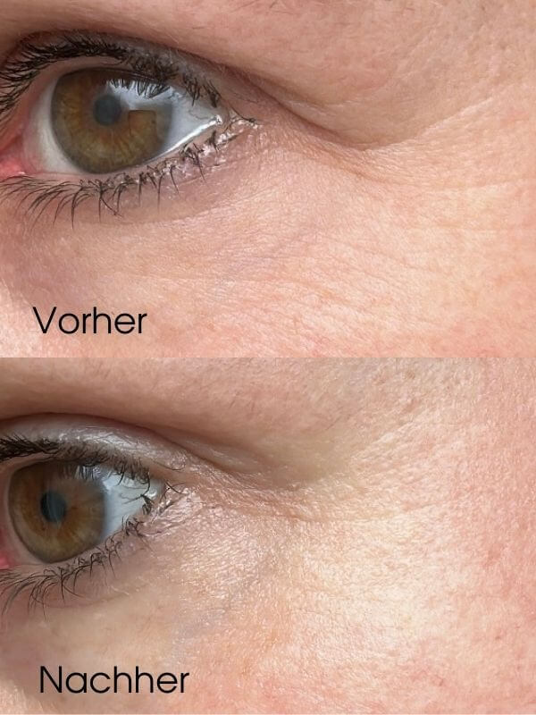 Krior Kennenlernset gegen Falten mit Kältetherapie